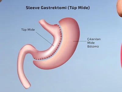 Ihre Gesundheit in besten Händen bei der Magenverkleinerung Türkei Beste klinik